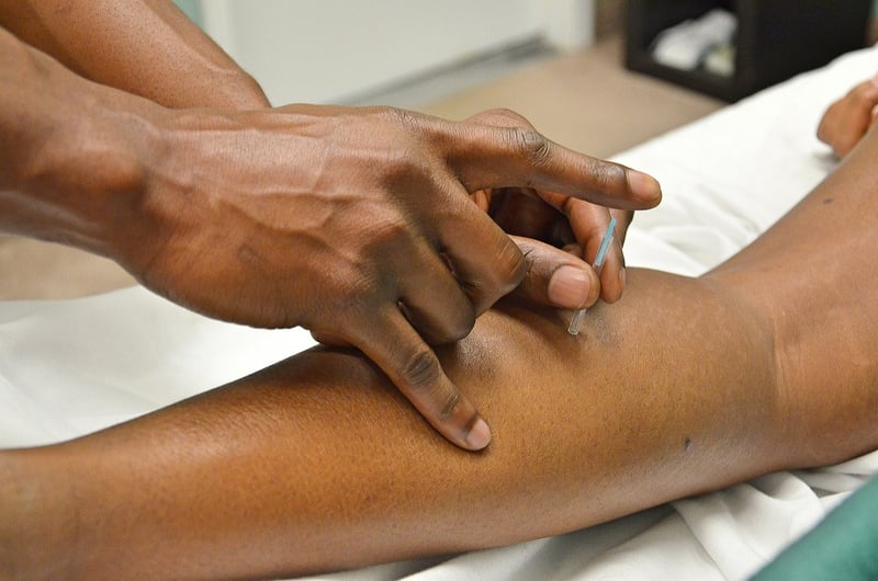 Acupuncture Therapy